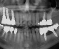 implant1-page